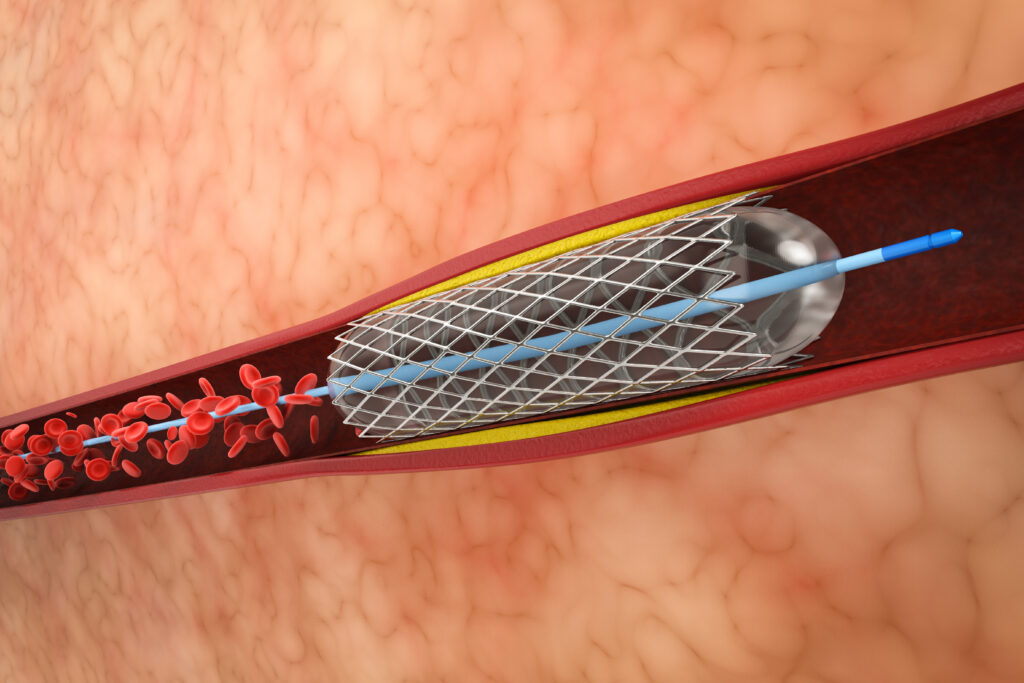 Angioplasty in Sarjapur Road